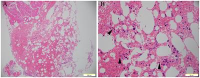Eosinophilic gastroenteritis in an elderly men associated with antibiotic use post maxillofacial space infection: a case report